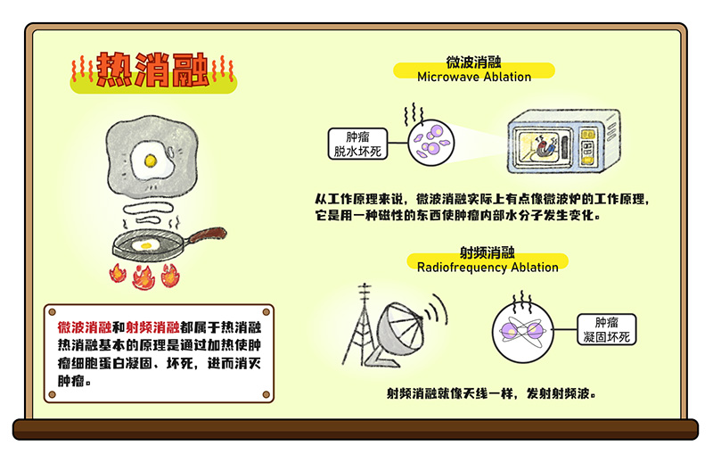 肺结节的消融治疗