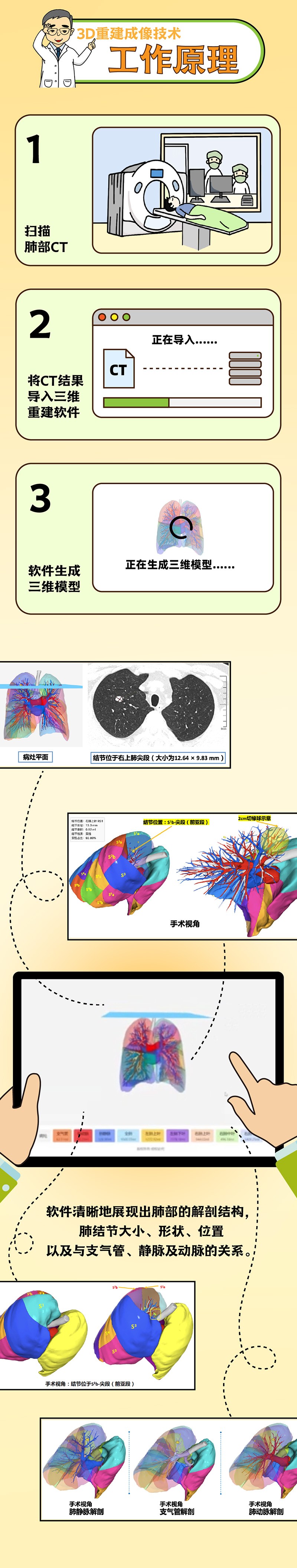 肺结节小剧场 vol10 ｜3D重建成像技术——助力微创精准切除